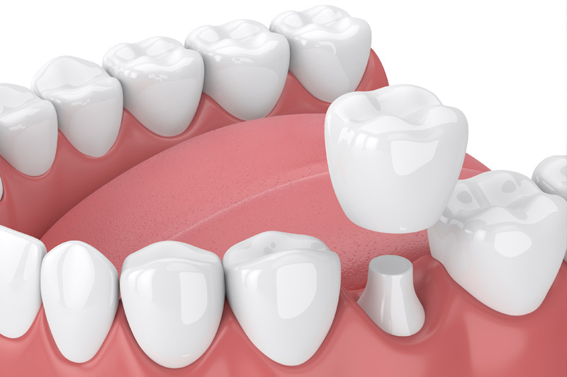 Dental Crowns in Prairieville