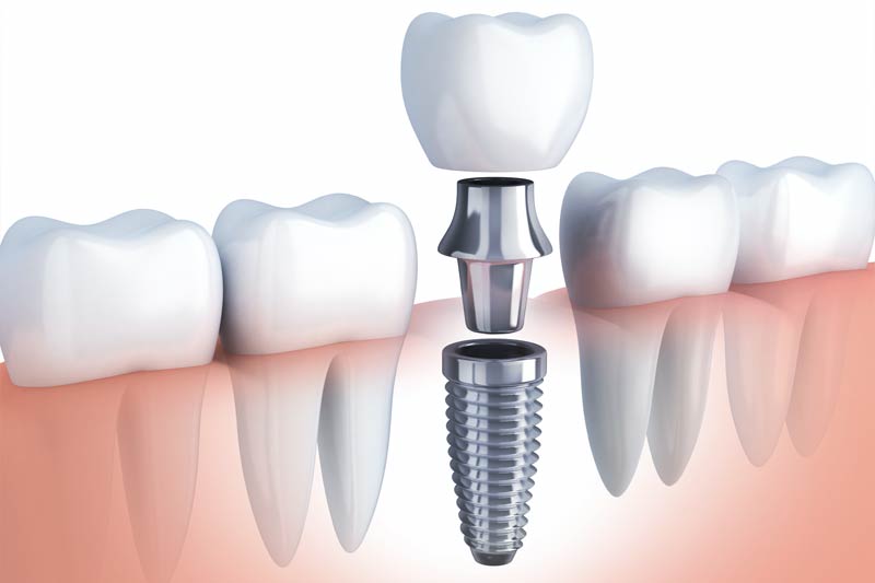 Implants Dentist in Prairieville