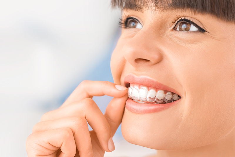 Invisalign in Prairieville