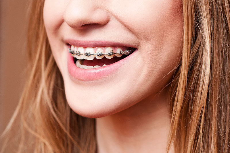 Orthodontics in Prairieville