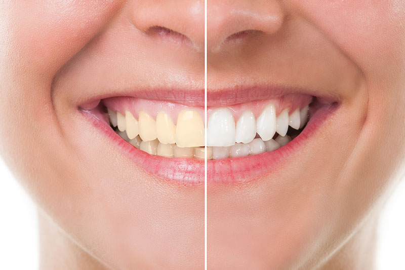 Teeth Whitening in Prairieville