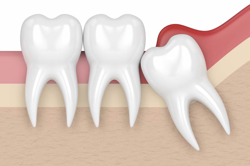 Wisdom Tooth Removal in Prairieville